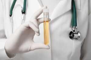 Close-up of a doctor’s white-gloved hand holding a test tube filled with a urine sample.